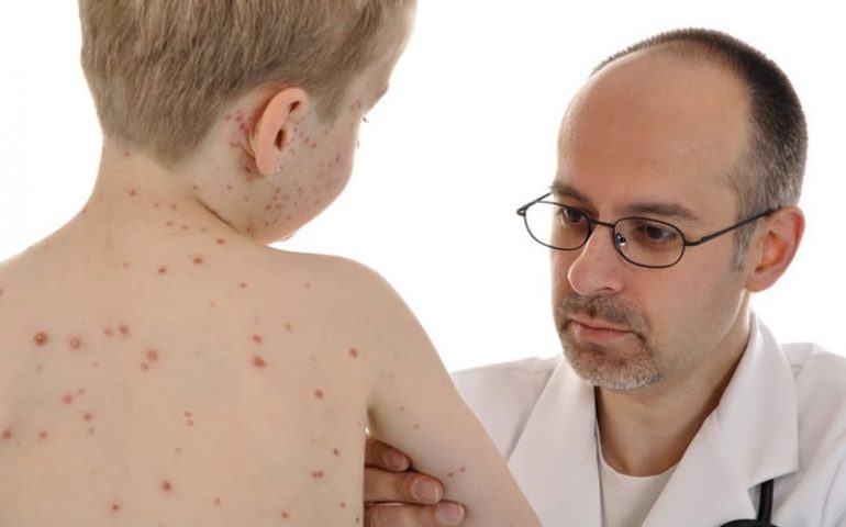 Morbillo, casi in aumento dopo la flessione del 2015. Italia seconda in Europa per incidenza