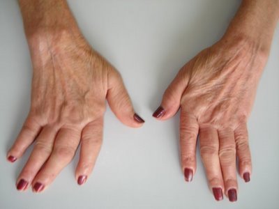Sanità: per i malati di artrite reumatoide si apre uno spiraglio