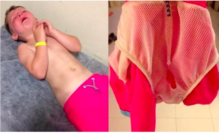 Sant’Antioco, costumino da bagno difettoso provoca una profonda ferita a un bambino di due anni