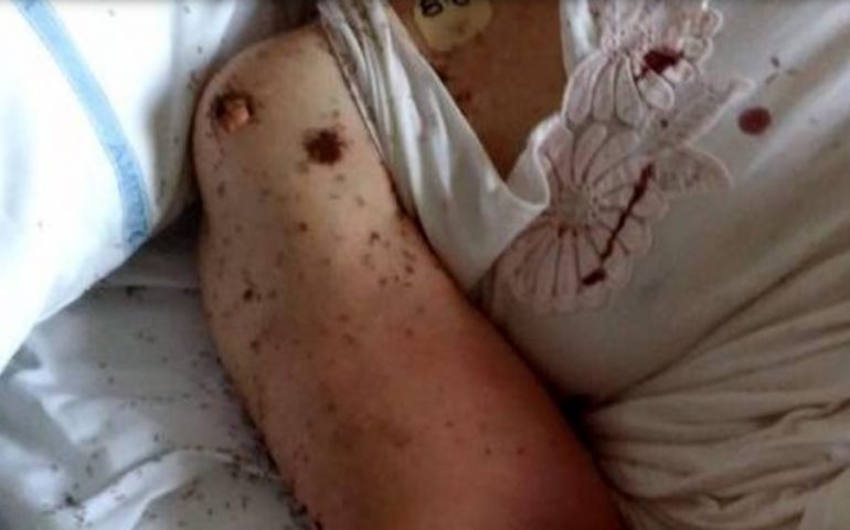 Orrore in un ospedale di Napoli: donna intubata ricoperta di formiche (VIDEO)