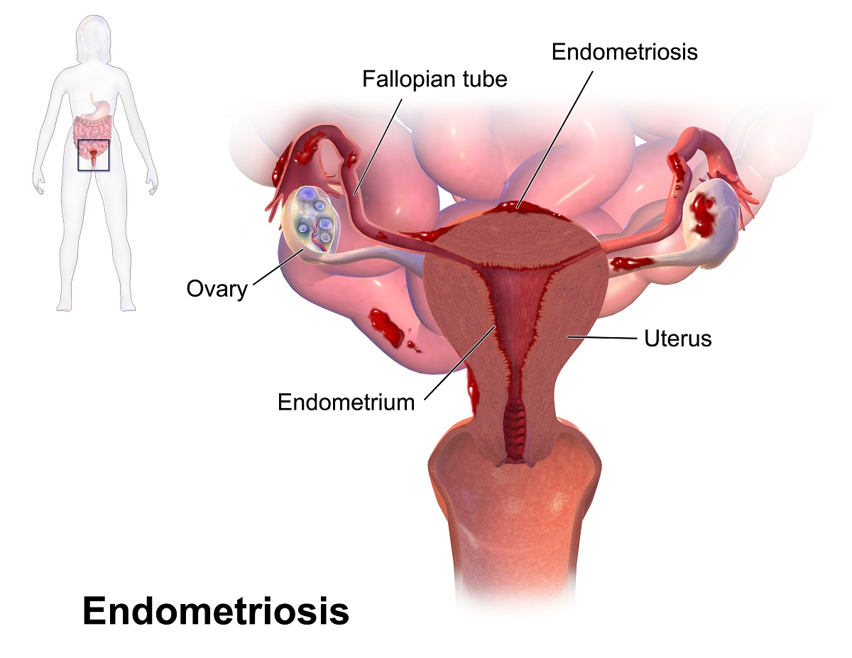 Endometriosi