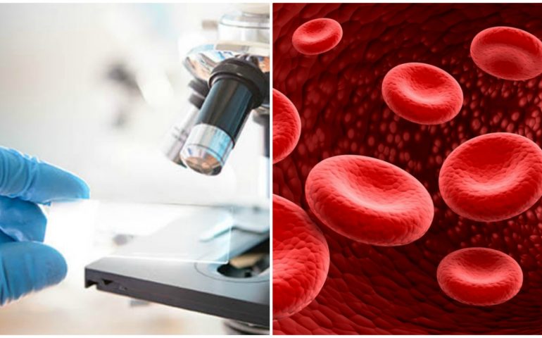 Nuova terapia genica contro la talassemia: lo studio dell’Università di Cagliari secondo al mondo