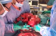 Intervento record al Mater Olbia: rimosso un tumore di 12 kg da un paziente di 53 anni