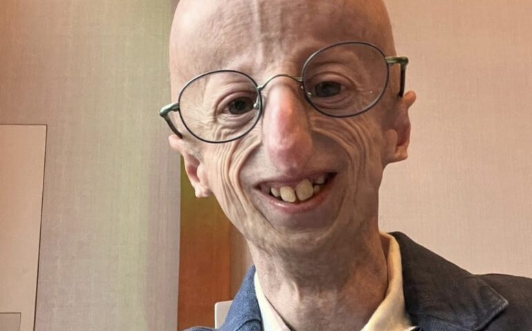 Muore Sammy Basso, fatale un malore in ristorante: il 28enne era malato di progeria