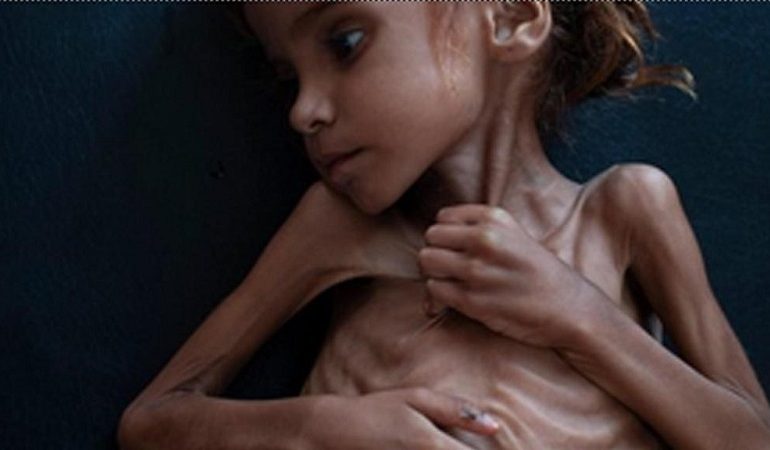 È morta di fame Amal Hussein, la bambina simbolo del conflitto nello Yemen